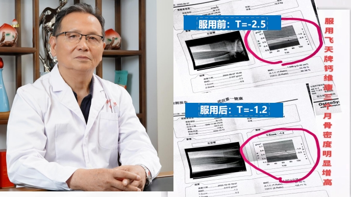 祥鹄案例|3个月，骨密度数值回升近50%！陈义民教授的骨质疏松逆转记！