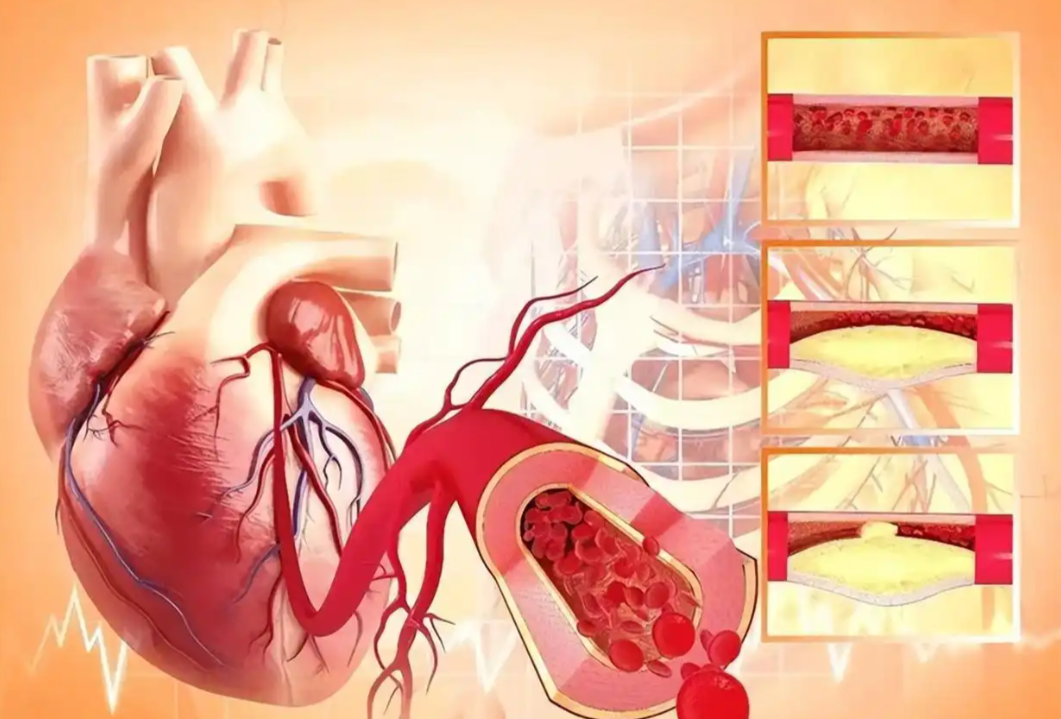 血瘀是大病的开端！航天科技破解血管“隐形杀手”，千万人健康告急